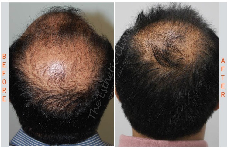 GFC Hair Treatment, gfc  before after photos in mumbai india 